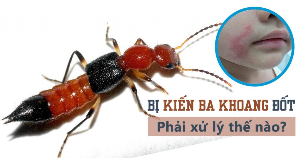 Xử lý khi bị kiến ba khoang đốt  